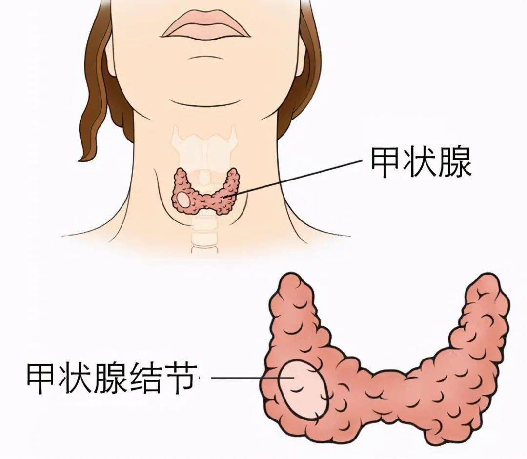 江西甲状腺最好的消融手术-江西甲状腺最好的消融手术医院排名